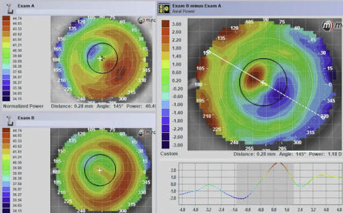 Orthokeratology for the post-LASIK cornea - eyeonoptics