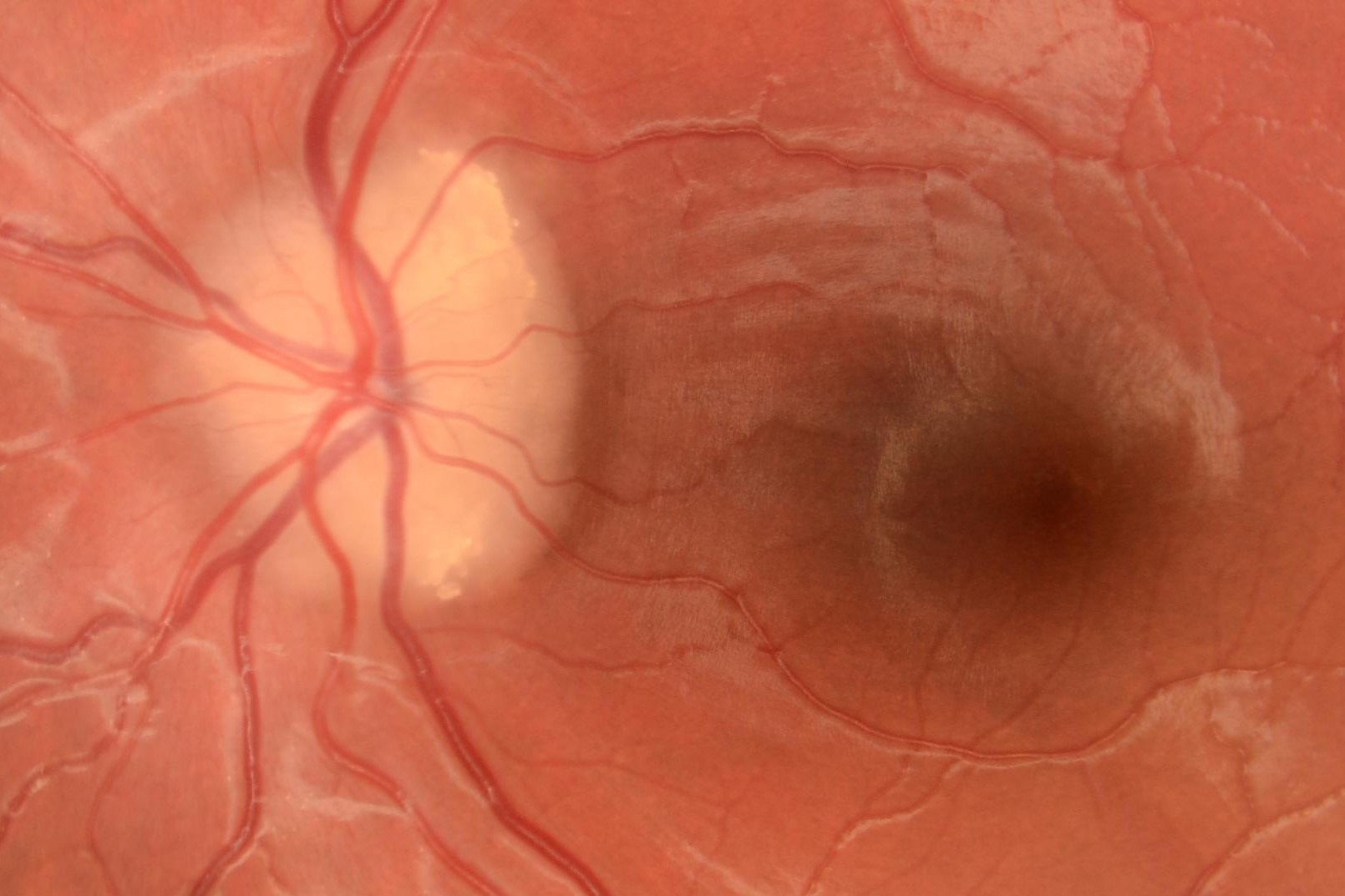 Optic Disc Drusen And Pseudo papilloedema Eyeonoptics