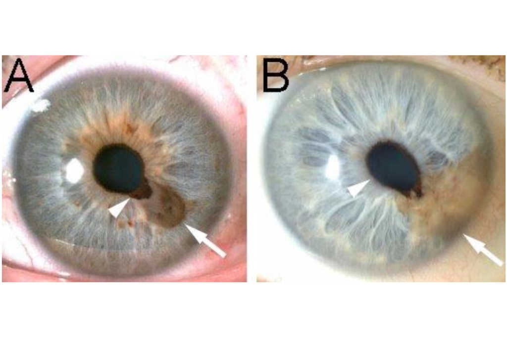 The iris in health and disease: part 1 - normal variations and mass lesions