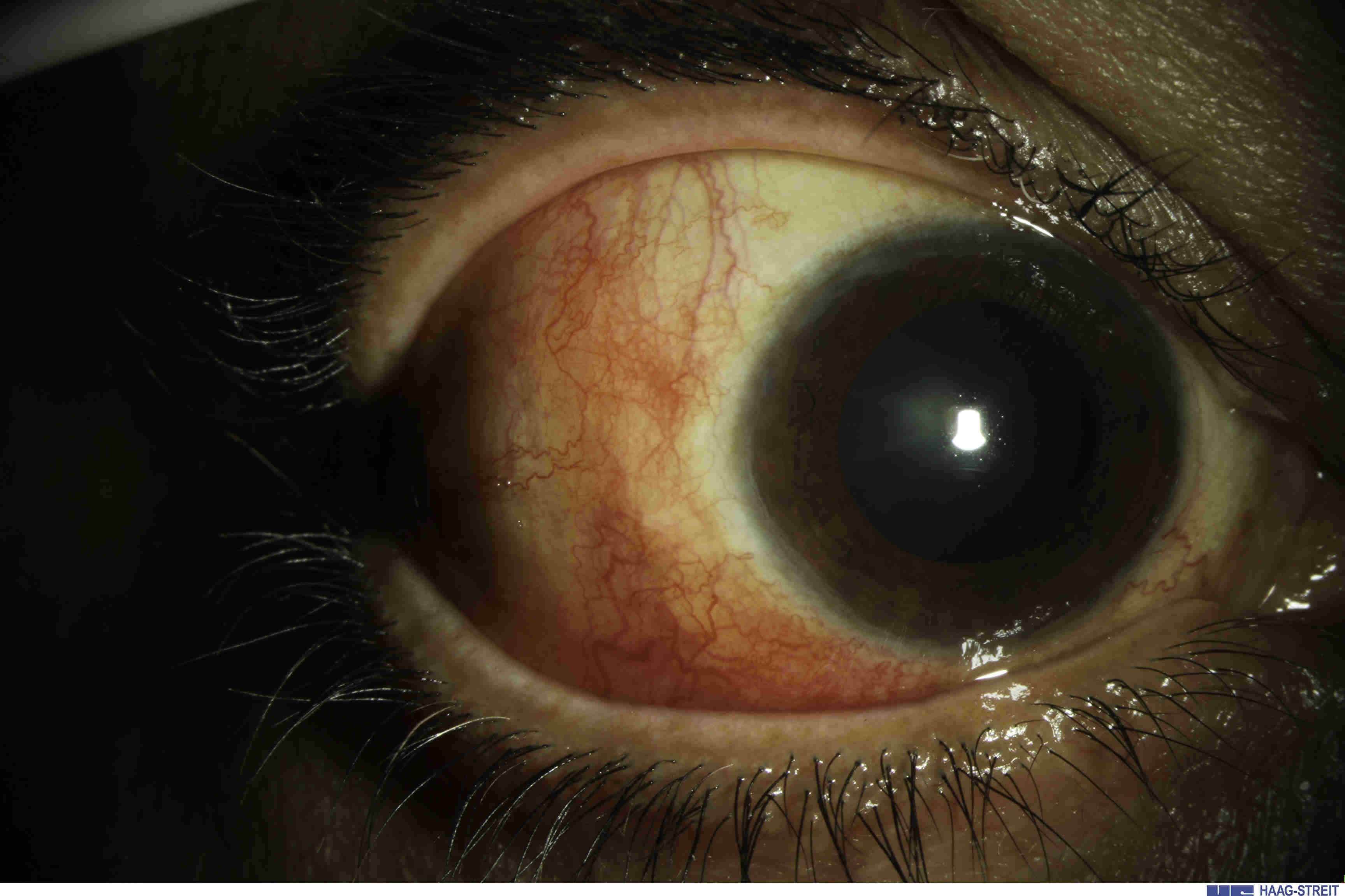 Fig.1 Anterior non-necrotising scleritis