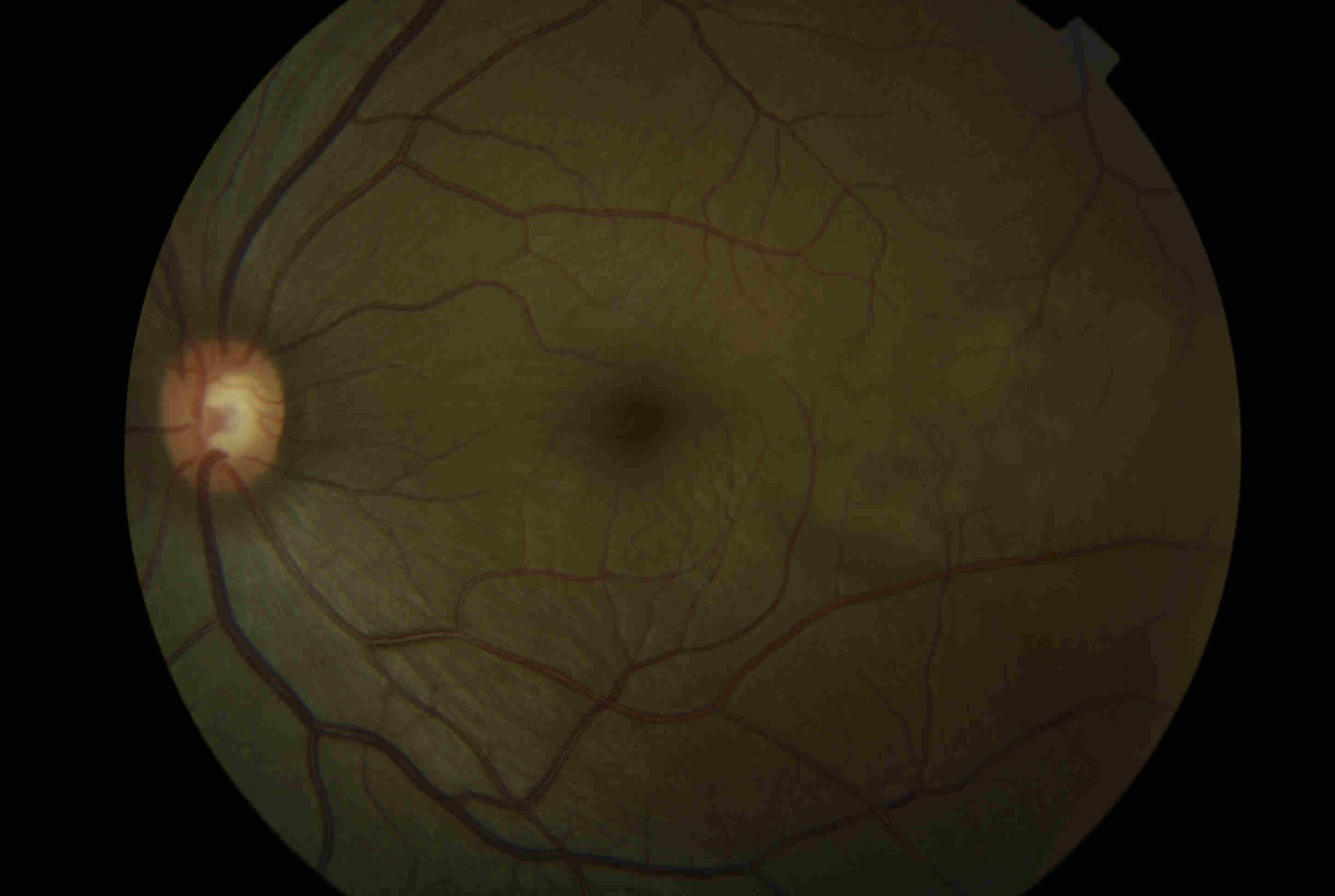 Fig. 2 Posterior scleritis showing choroidal folds and exudative retinal detachment